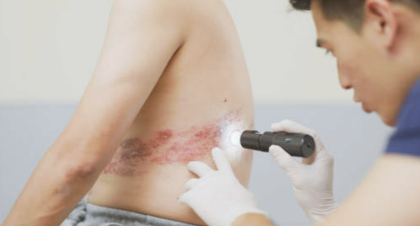 대상포진 예방접종 가격(최저가) 초기증상 치료방법 총정리