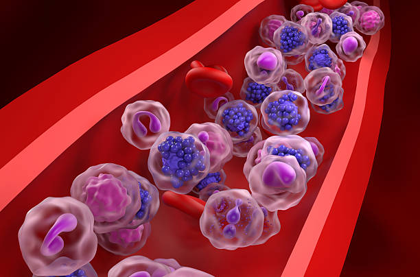 백혈병, 꼭 알아야 할 원인·증상·예방·치료법