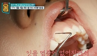 잇몸염증없어짐