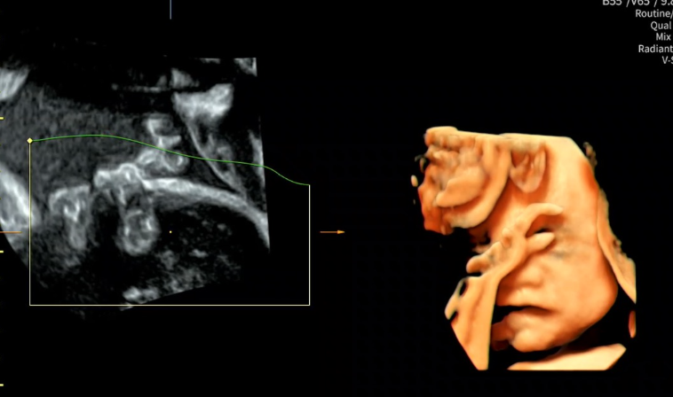 쌍둥이 임신 28주차(7개월)