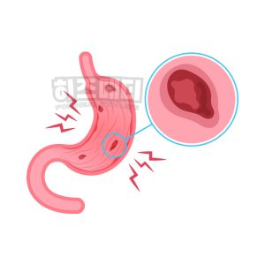 철결핍성 빈혈 원인 증상