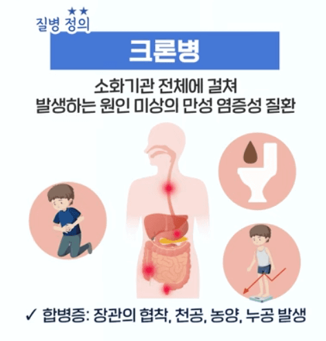크론병