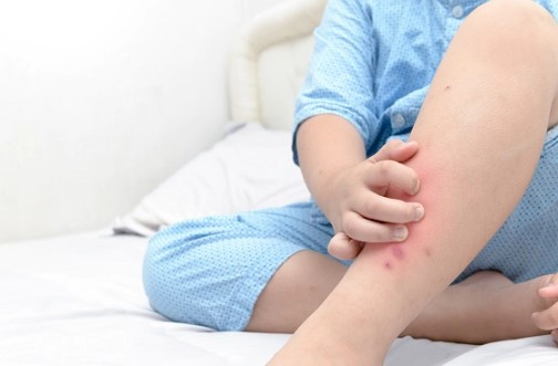 아토피에 좋은 오일 추천