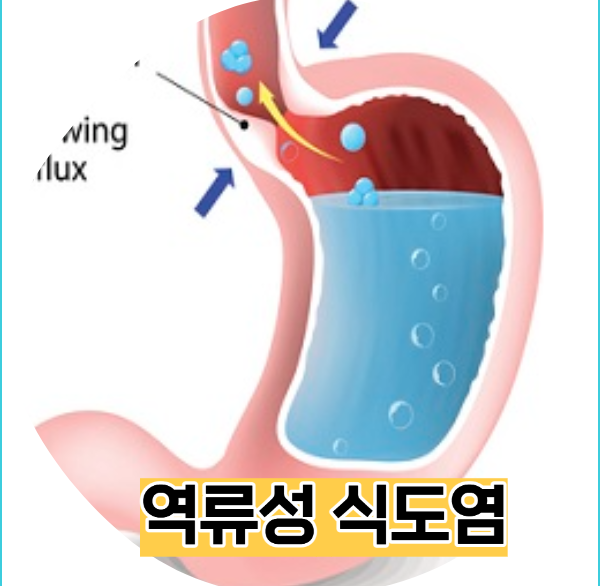 역류성식도염