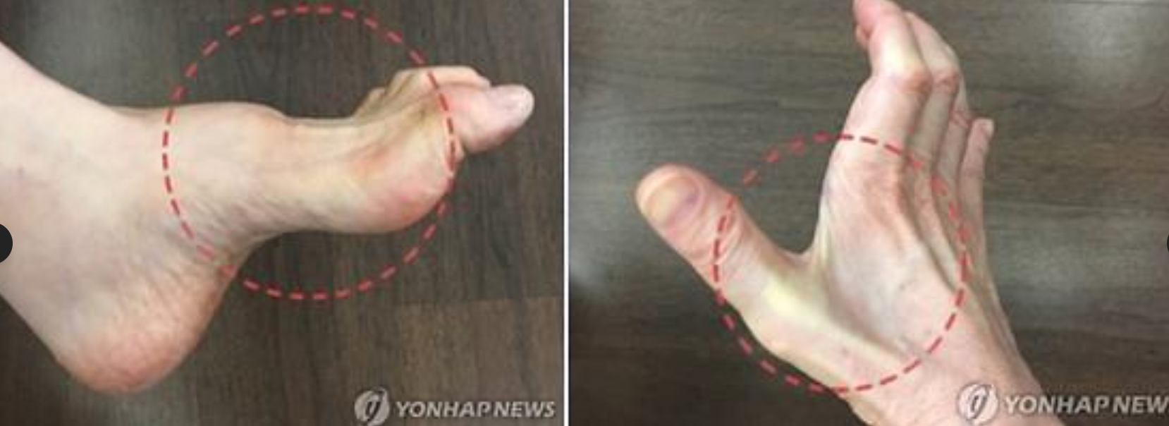 삼성가 이부진 사장 걸음걸이와 샤르코 마리 투스 유전병 팩트체크