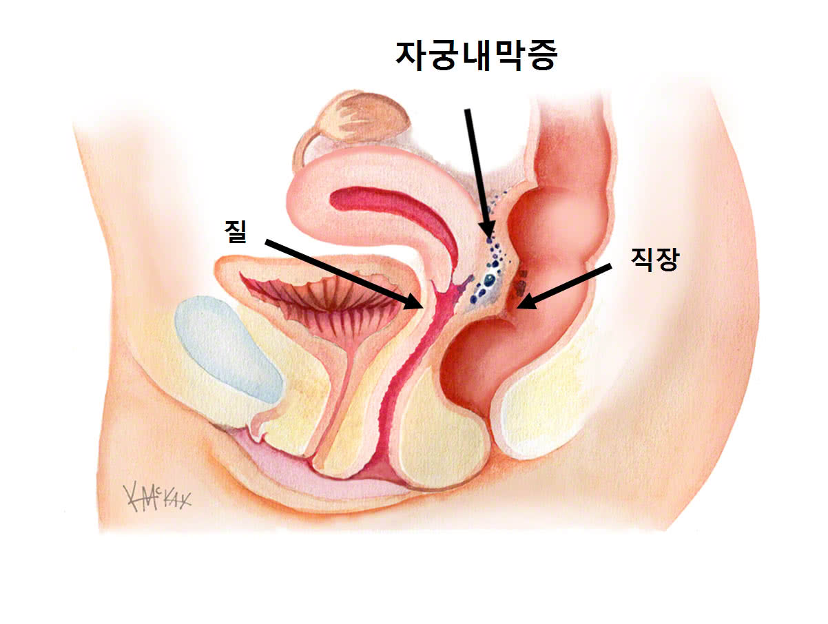 장궁내막증