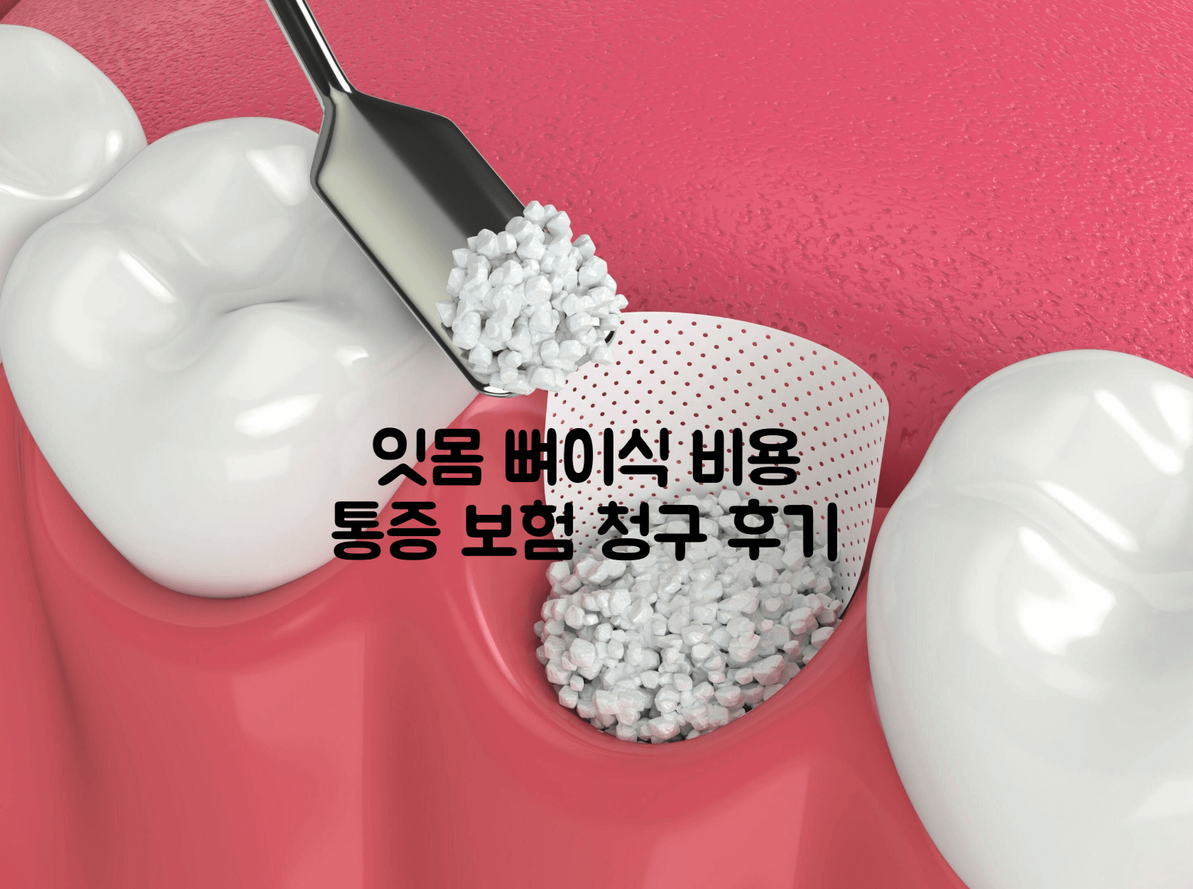 잇몸 뼈이식