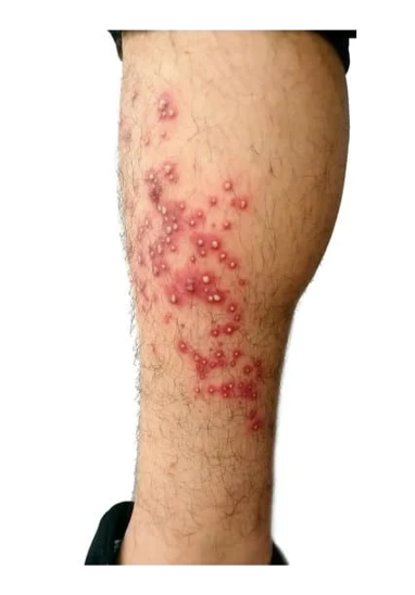 모낭염 원인과 치료방법