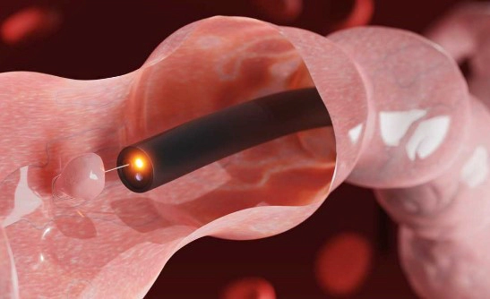 대장내시경 전 먹어도 되는음식 7가지