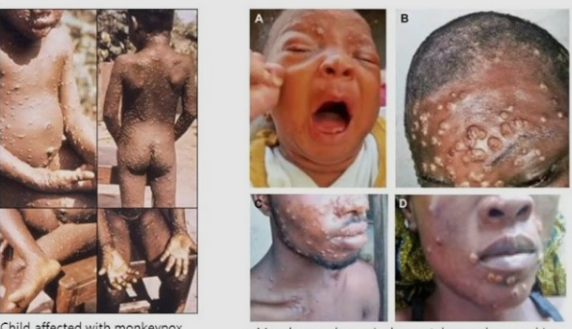 원숭이 두창