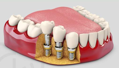 임플란트 보험청구