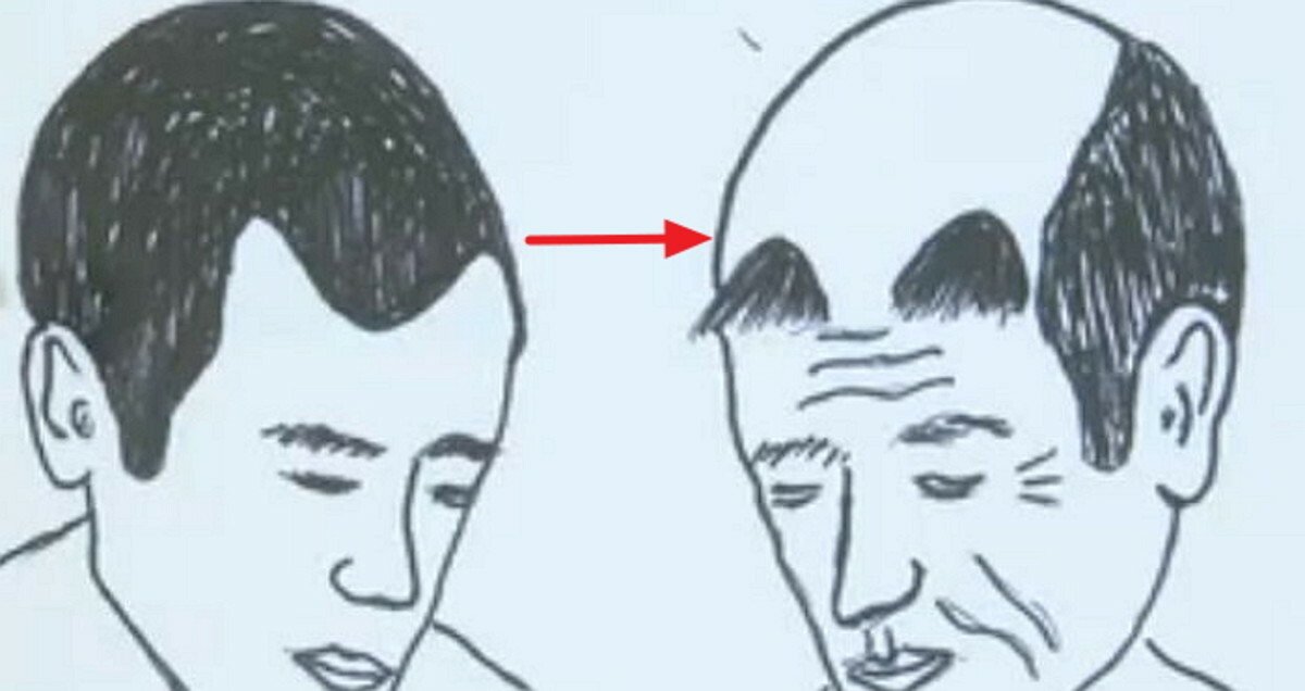 모발이식-부작용-모발이식더듬이