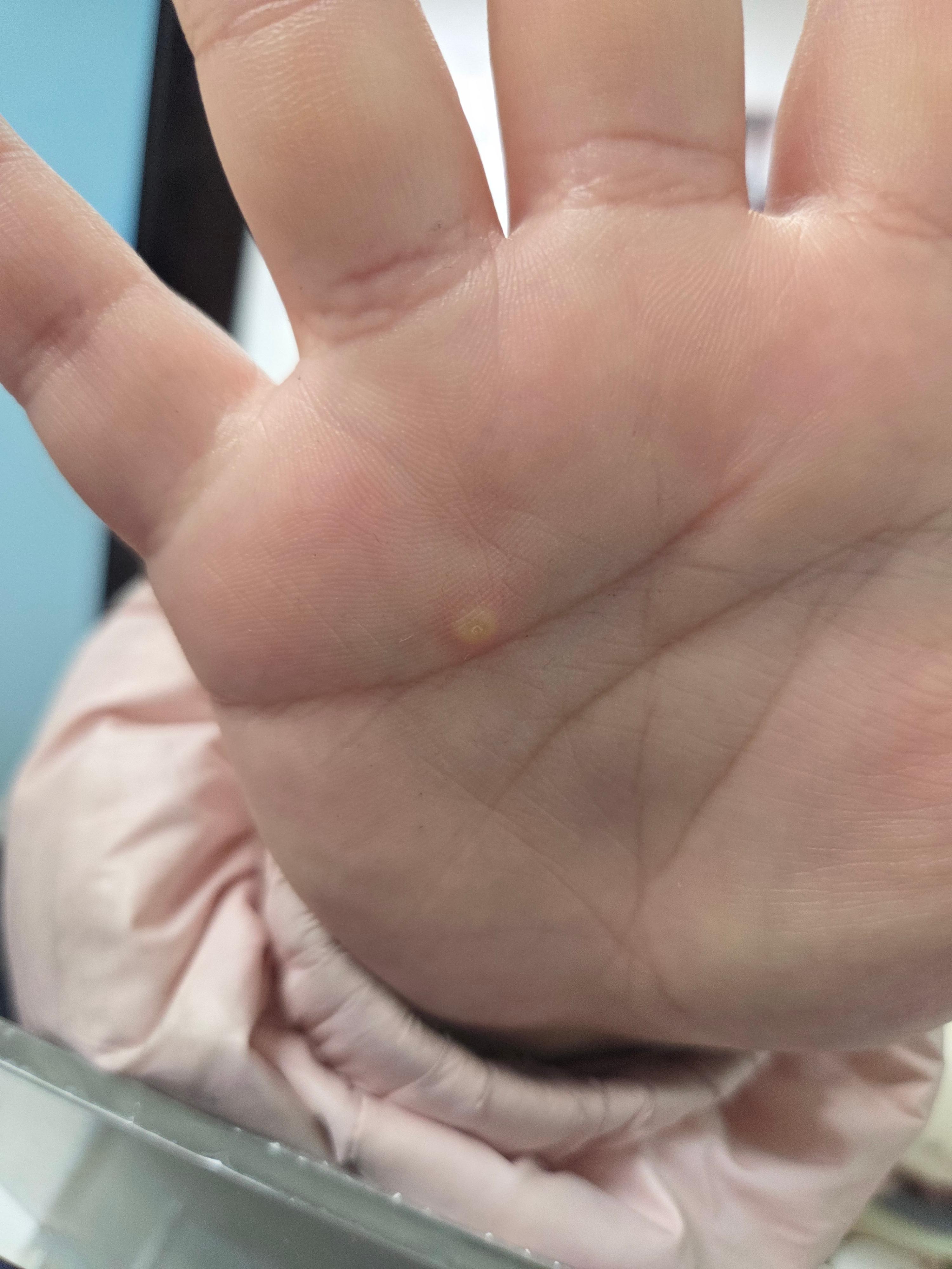 바이러스성 사마귀의 모습