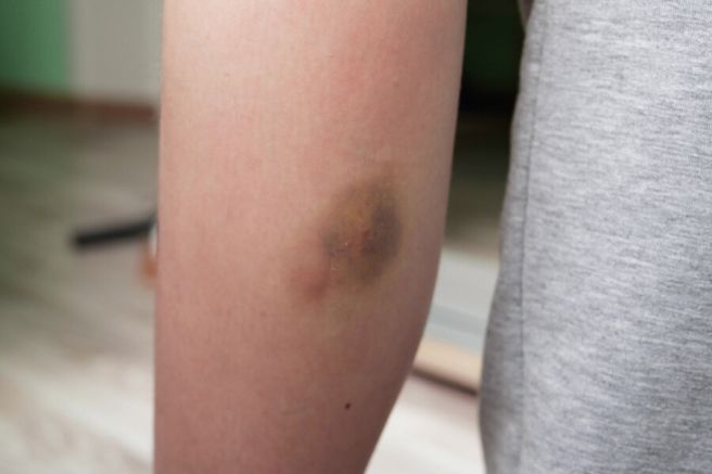 몸에 멍이 잘드는 이유