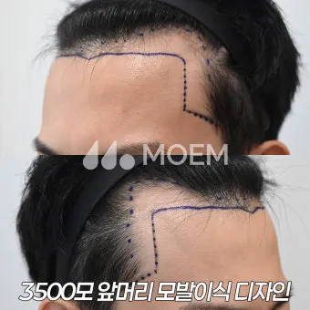 머리카락 이식 3000모 3000모낭 비용과 시술 과정_3