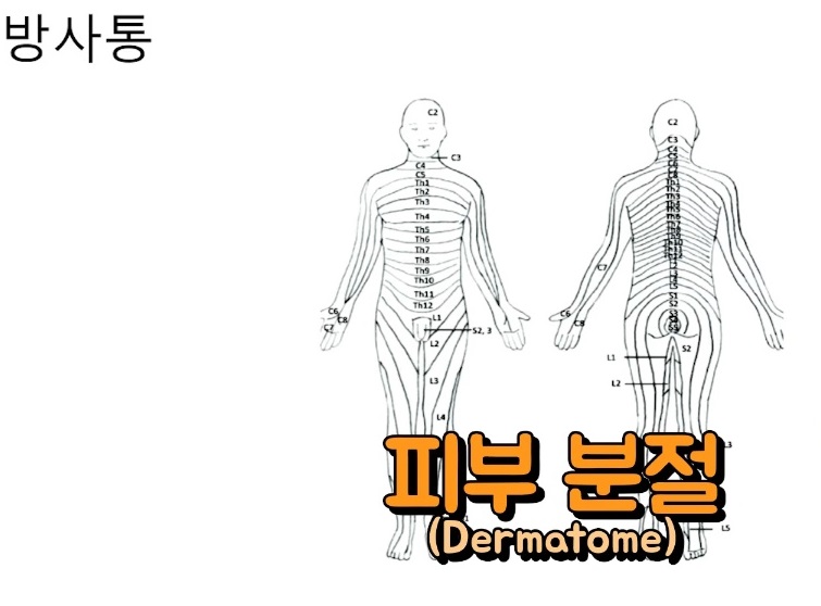 하지방사통-방사통-이준석교수-문호식교수
