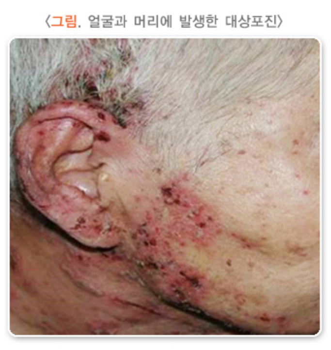 대상포진