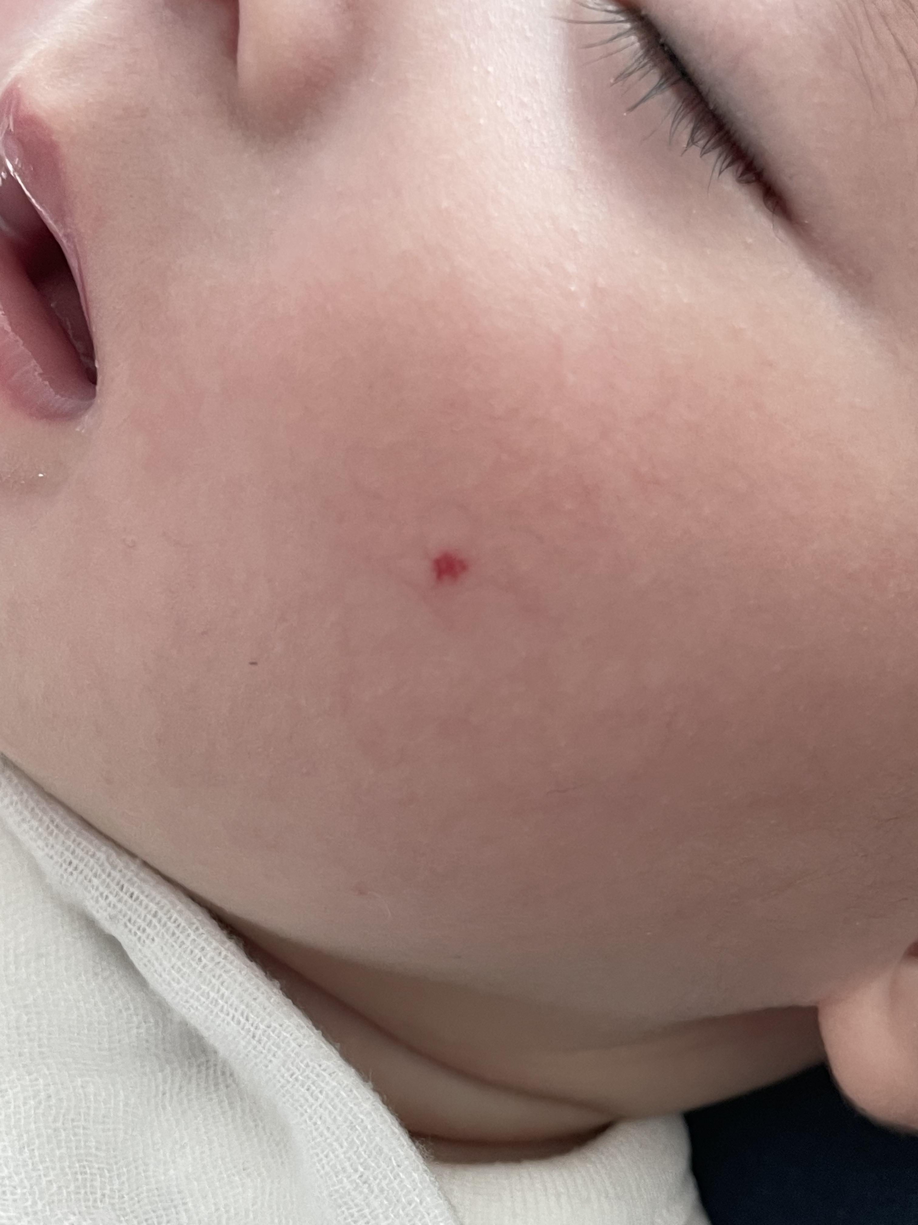 혈관종 에스앤유 피부과