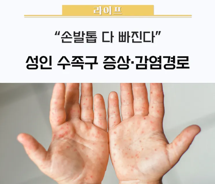 수족구 어른 전염에 대한 원인과 예방법 정리_3