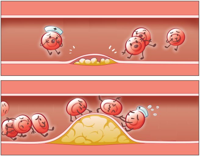 ldl 콜레스테롤 낮추는 방법