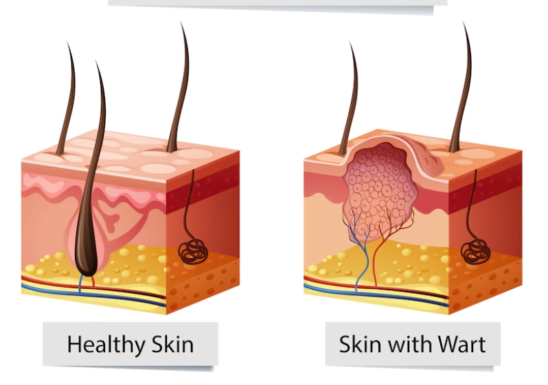 정상적인 피부와 사마귀가 생긴 피부를 보여주는 이미지