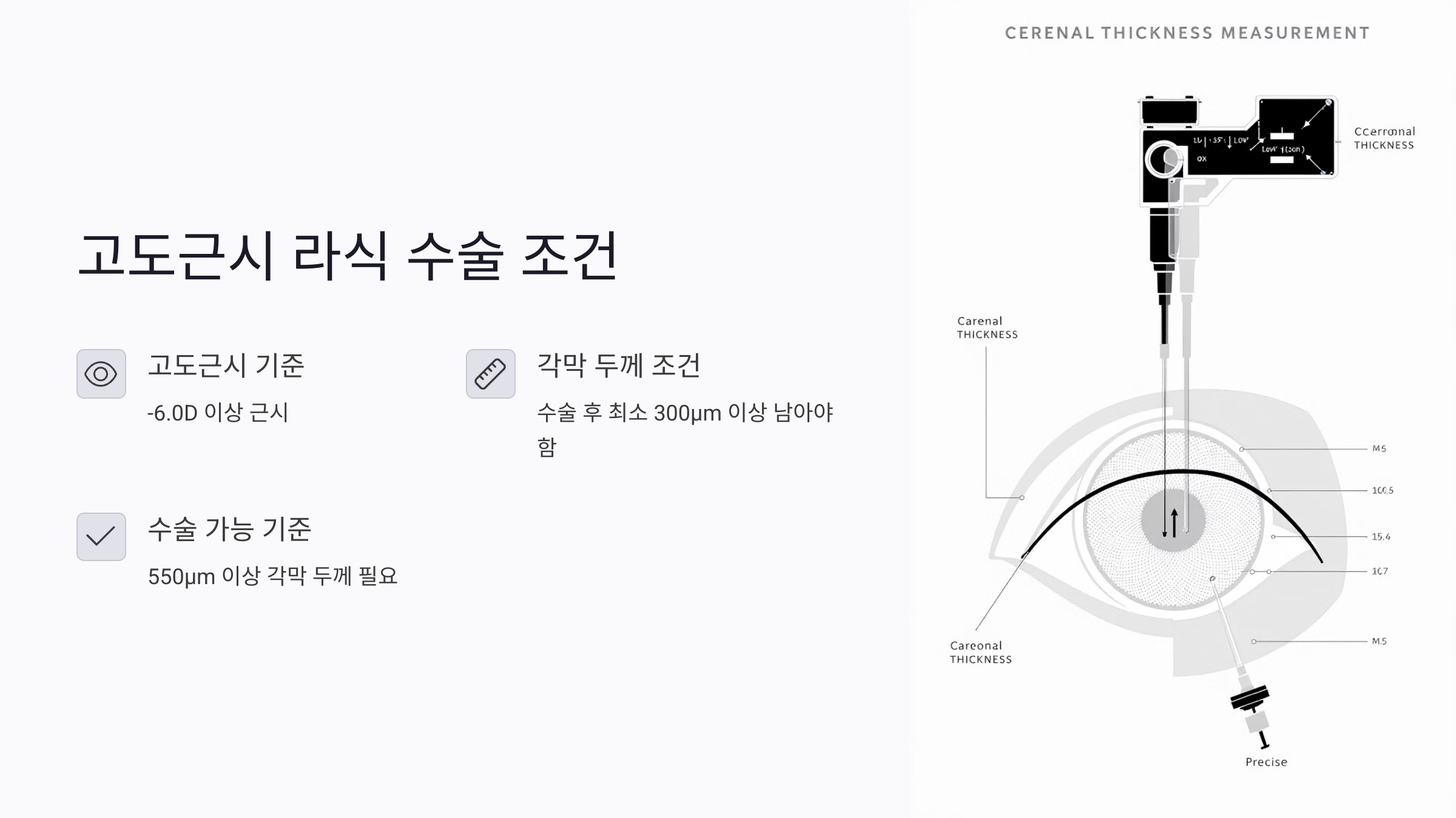 고도근시 라식 각막 두께 조건과 수술 가능 기준