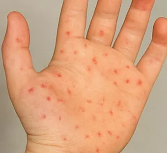 수족구 초기 증상 어른 감염 격리기간 예방 치료 완전 가이드_5