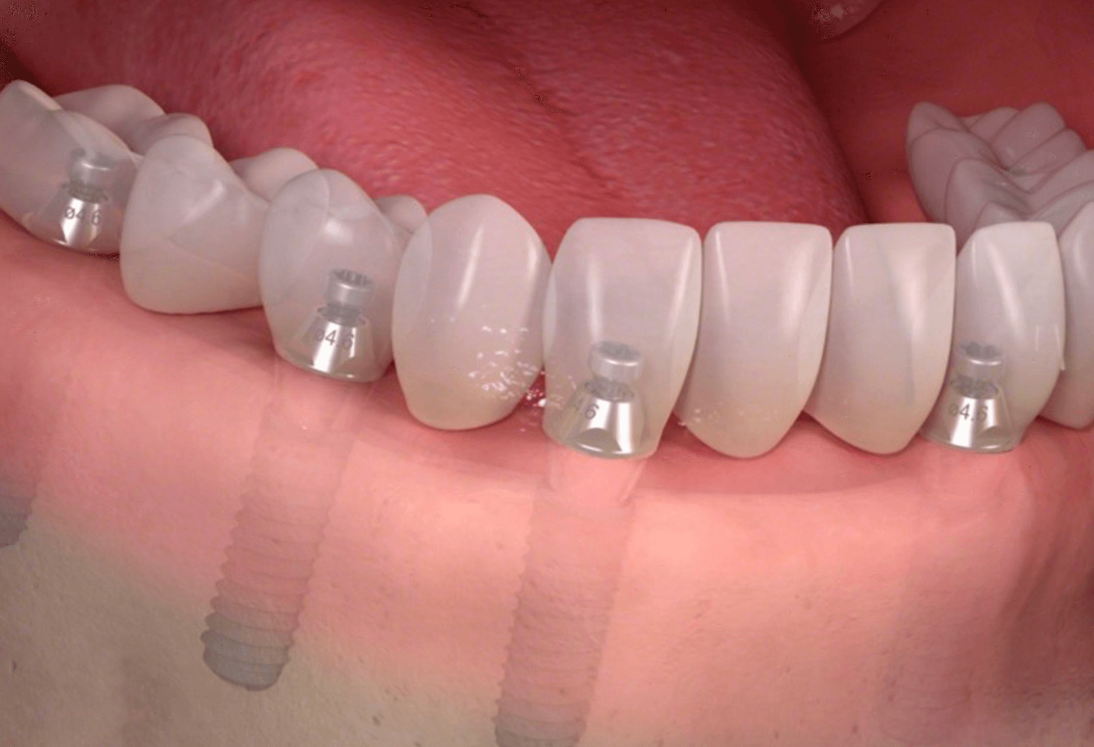 전체임플란트 후기