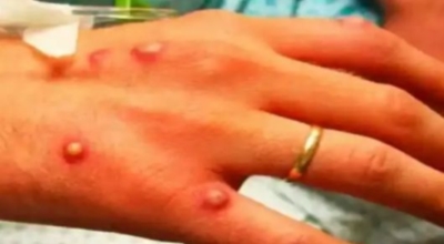 원숭이두창 이미지