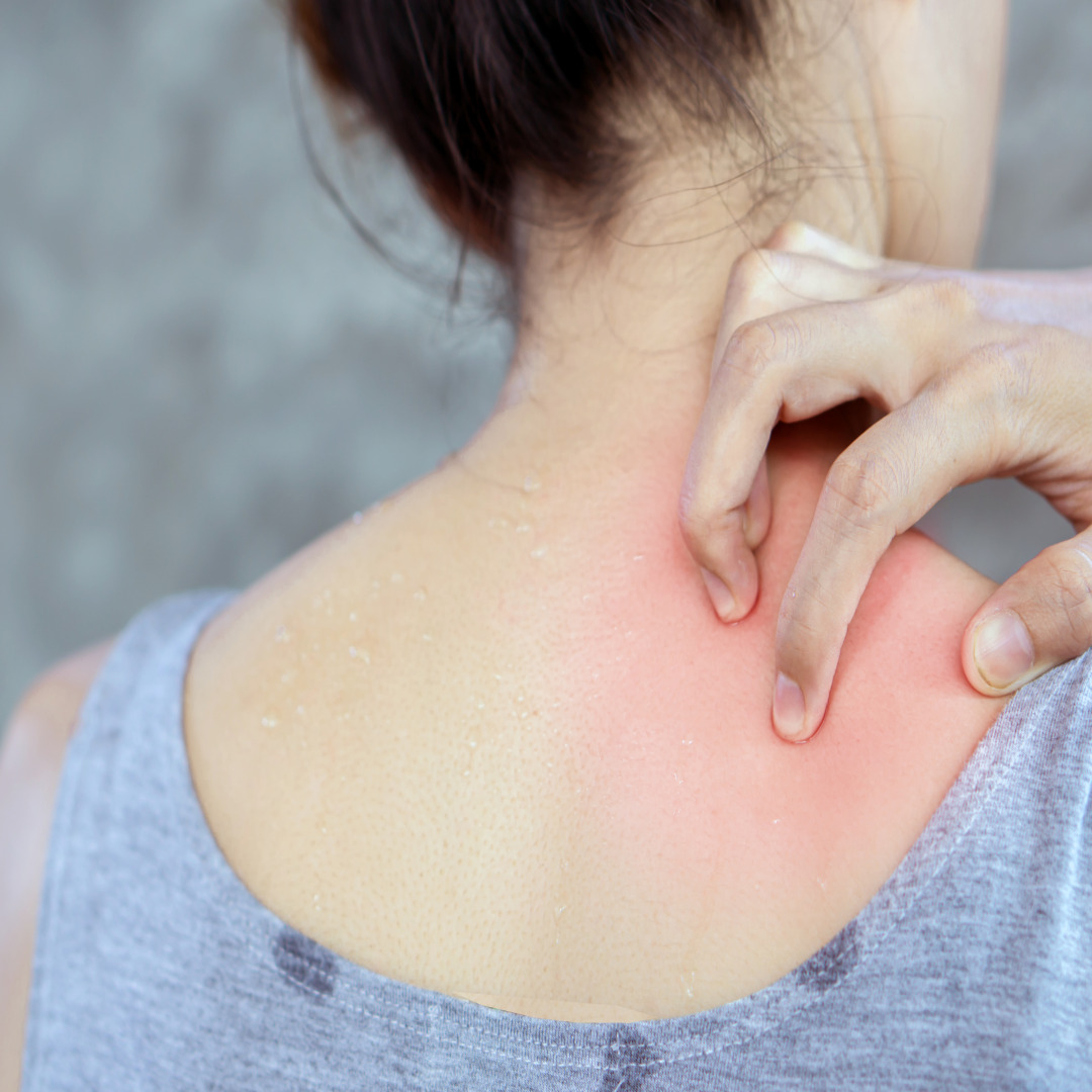 여름피부염 대처법 (알레르기, 땀, 환절기피부관리)