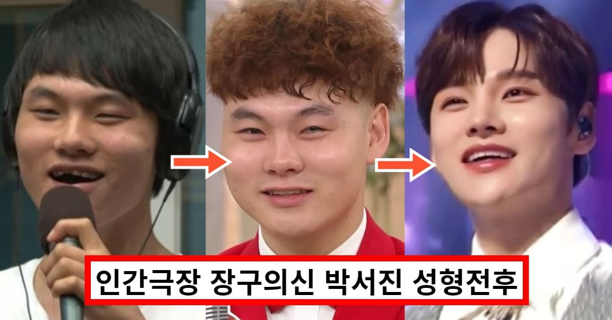 박서진 성형 변천사