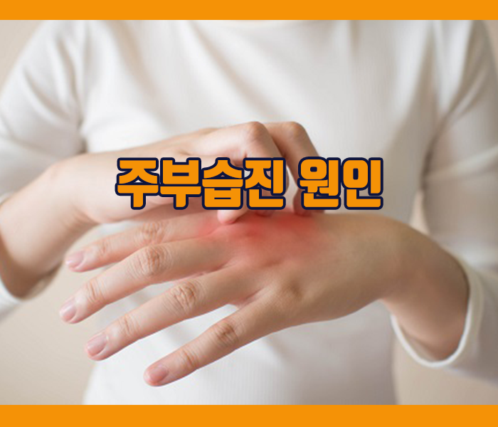 주부습진 원인 - 피부장벽손상, 환경적요인, 반복적인 세제사용, 유전적 요인 등