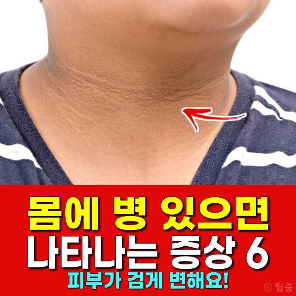 피부가 검게변하는 증상,당뇨병,팁줌