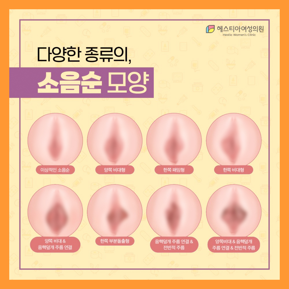 다양한 종류의 소음순 모양
