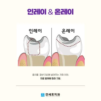 인레이 온레이의 차이와 치료 방법_2