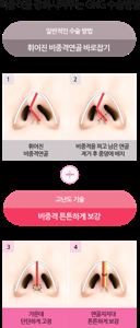 비중격 만곡증