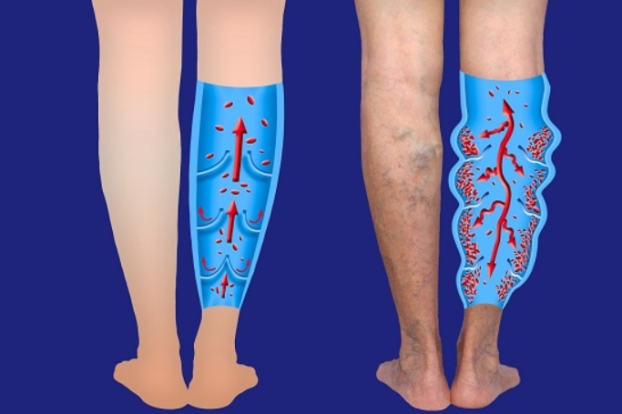 하지정맥류2