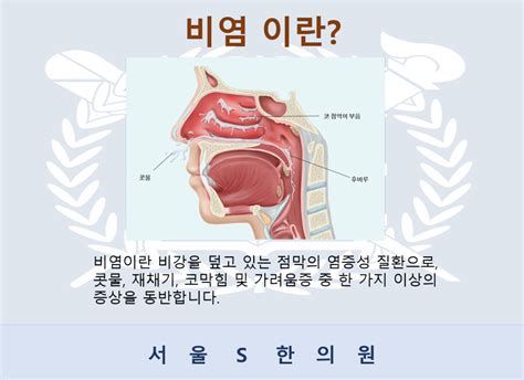 비염