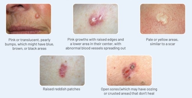 바이든 피부암 병변 - 기저세포암 증상, 기저세포암 치료