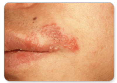 입술 단순 포진