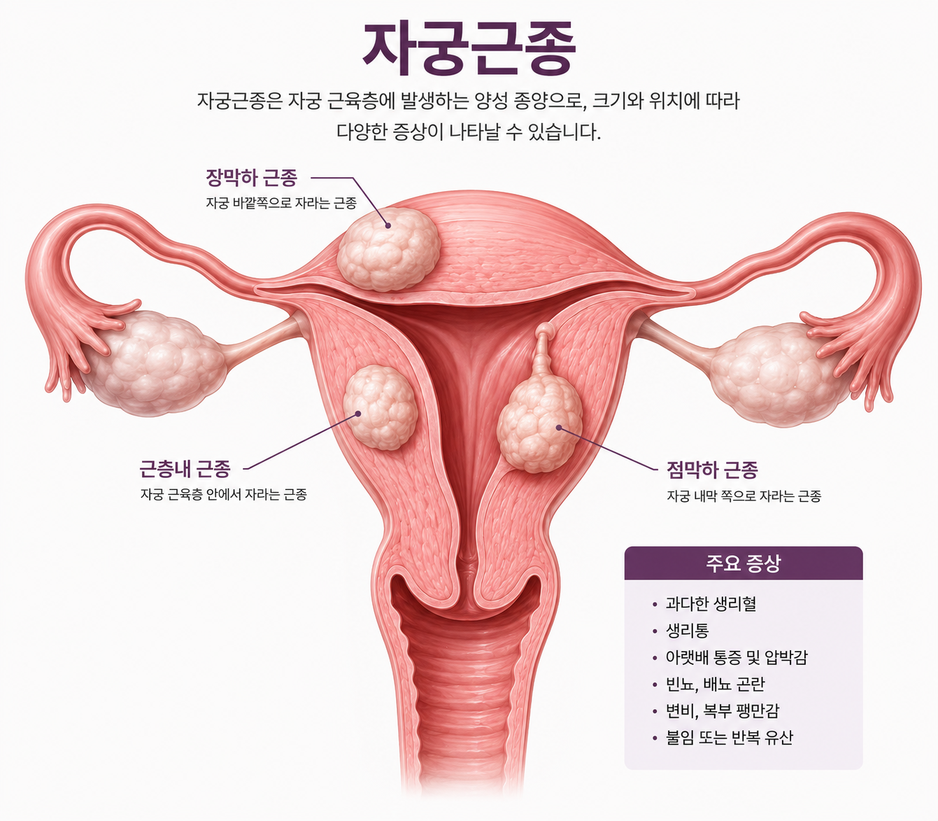 자궁근종 원인, 증상, 치료