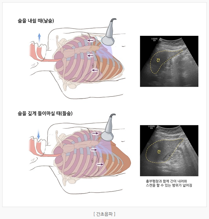 간암