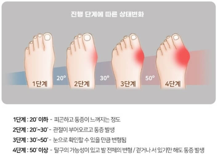 무지외반증 단계별 진행 상태