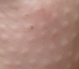 리쥬란힐러-엠보3