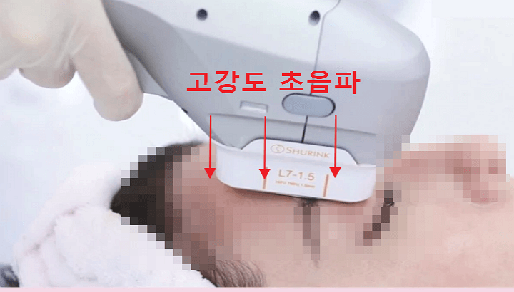 아이슈링크-초음파-쏘는-장면