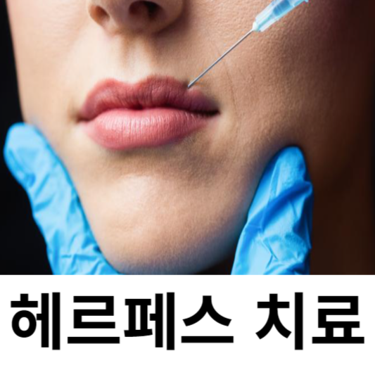 헤르페스 치료