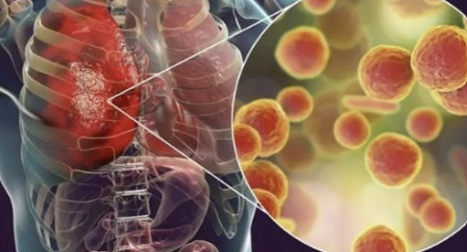 마이코플라스마폐렴증상