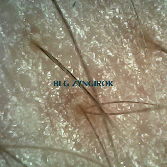 탈모 극복 프로젝트 - 오른쪽 M자 부위 두피 모습이다.