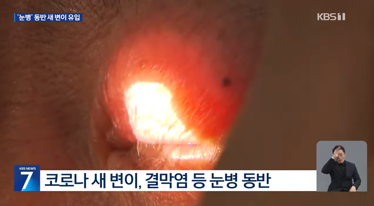 변이 코로나 바이러스 눈병