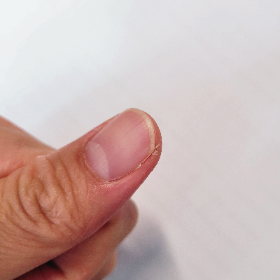 손가락 끝 갈라짐 원인